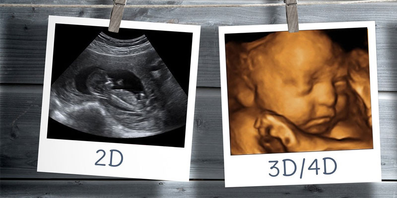 3D 4D Ultrasound